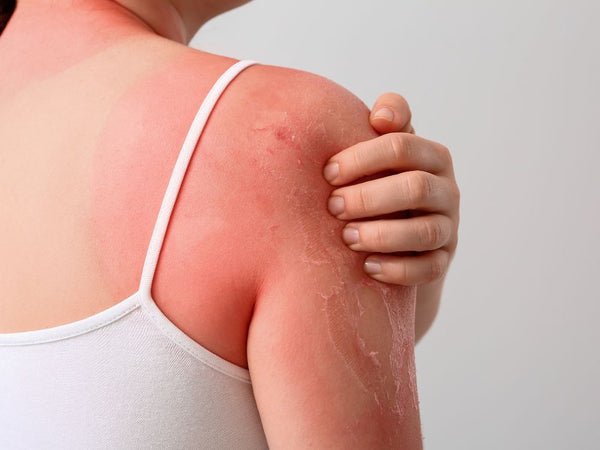 Gefahr Sonnenbrand: Welcher Hauttyp bin ich eigentlich?